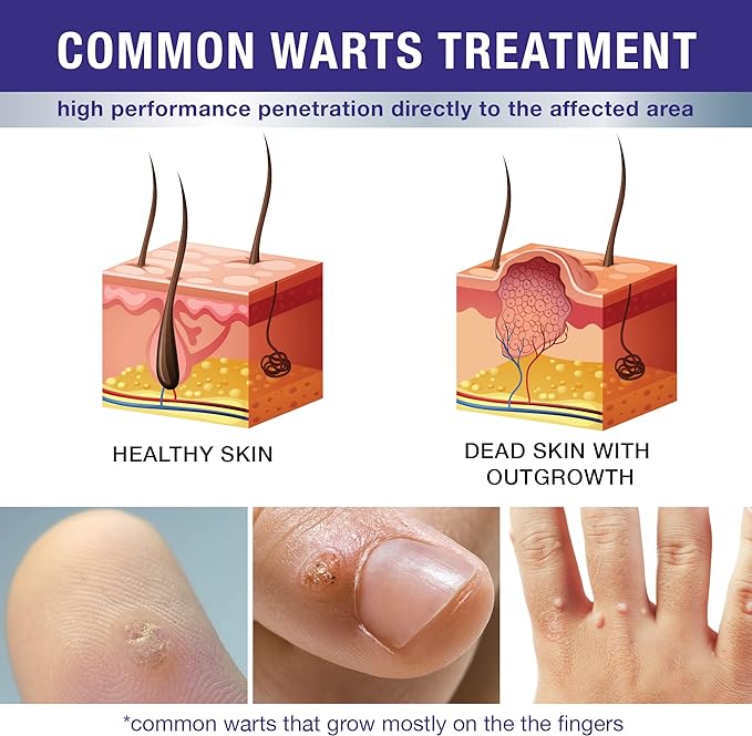 (B0BF74F7K5) - Dr. Luke Wart & Corn Remover for Toes Feet: Fast Acting Plantar Wart Common Wart Flat Wart Corn Removal